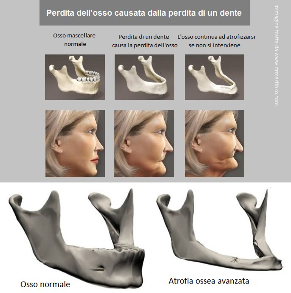atrofia ossea per perdita denti e perdita di dimensione verticale