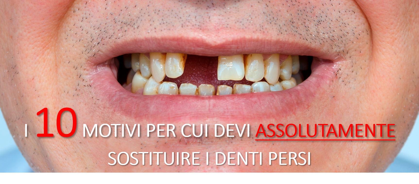 10 motivi per sostituire denti persi