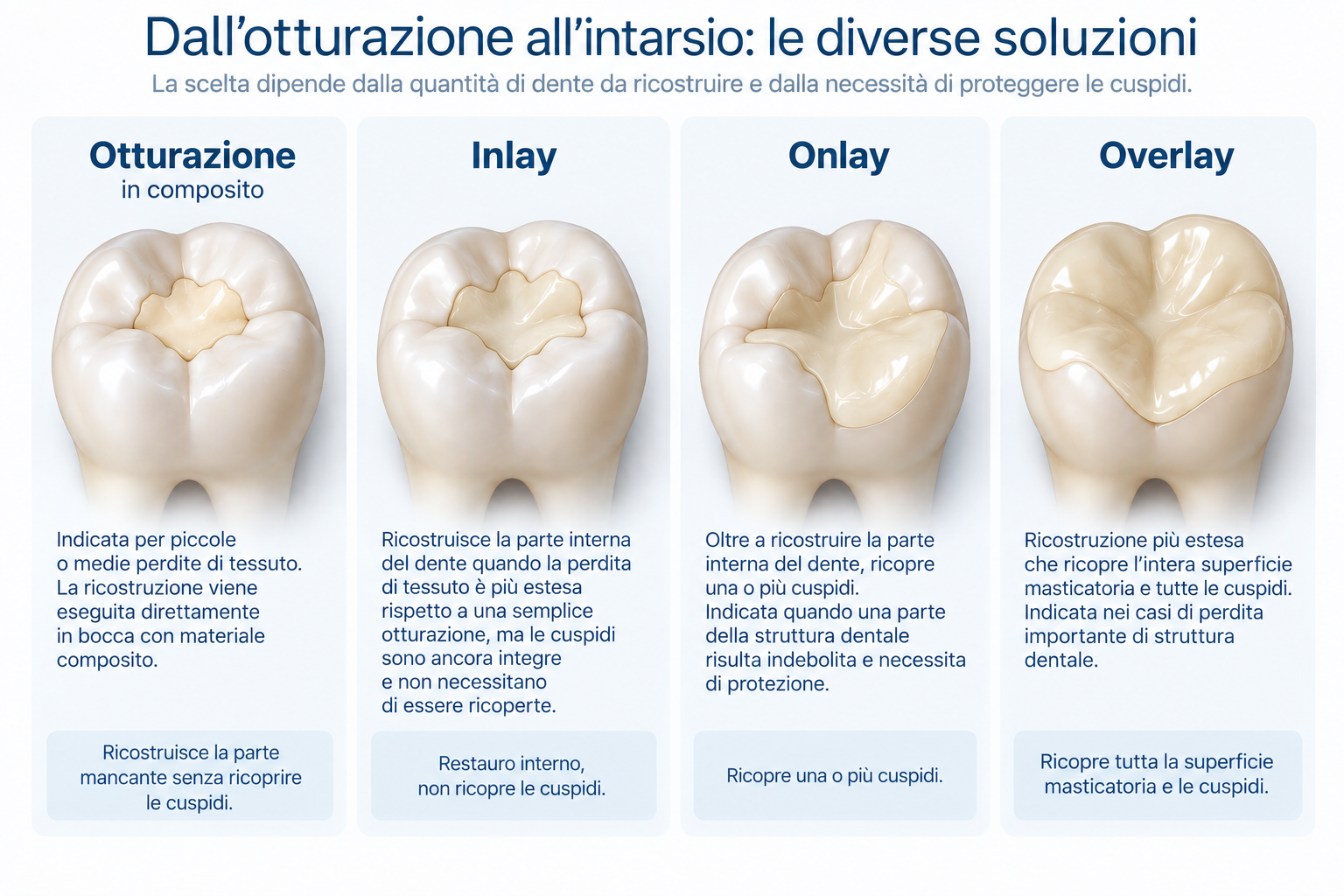 intarsi; inlay, onlay, overlay differenza tra inlay, onlay, overlay