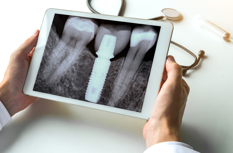 radiografia endorale digitale con impianto