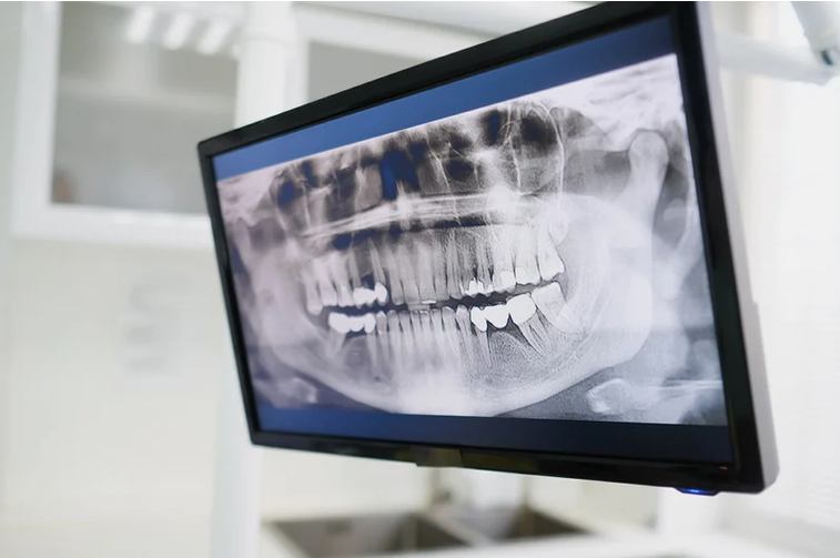 radiologia odontoiatrica studio dentistico Vinciguerra Torino Radiologia odontoiatrica e panoramica dentaria