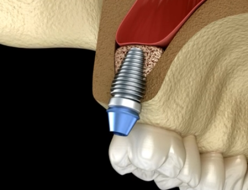 Implantologia dentale a Torino: cosa fare quando l’osso disponibile non è sufficiente?
